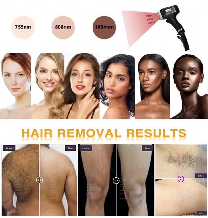 1800W Diode Laser Hair Removal Machine